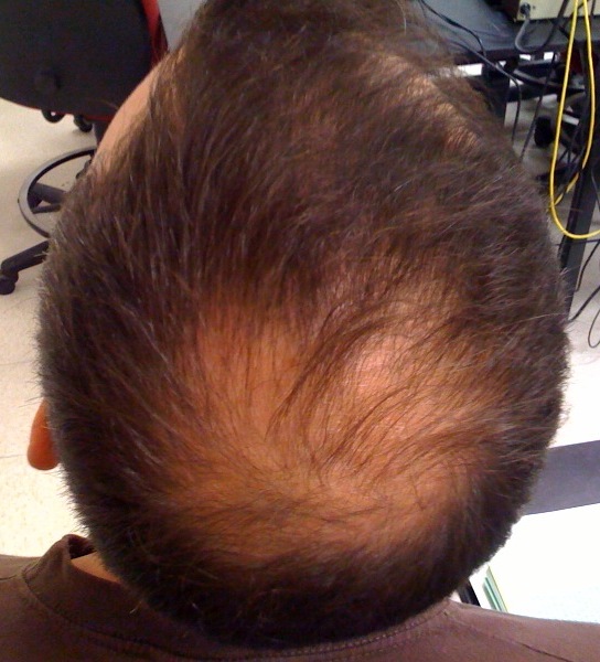 Hair loss