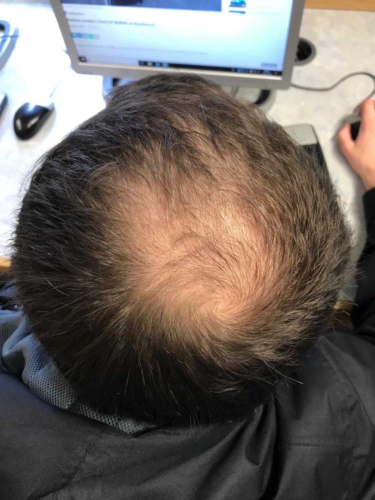 Pattern hair loss