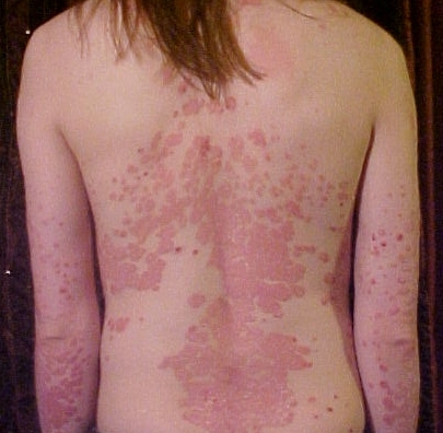 Psoriāze
